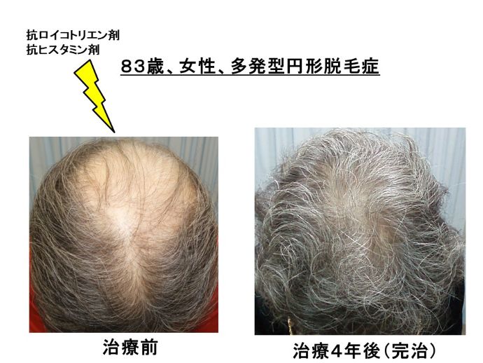 円形脱毛症　病院
